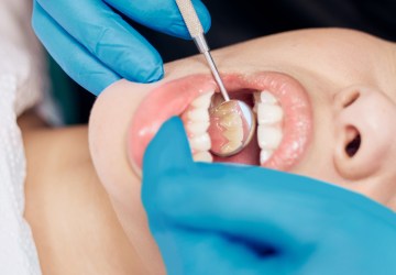 Como tratar e evitar os tártaros nos dentes?